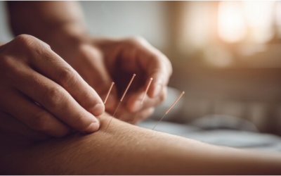 Acupuncture vs. Dry Needling: The Controversy